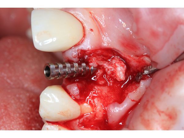 Установленный имплант с временным абатментом и трансплантатом из зоны бугра