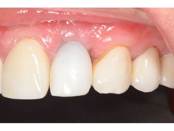Временная коронка через месяц после имплантации