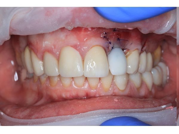 Временная корона в день имплантации