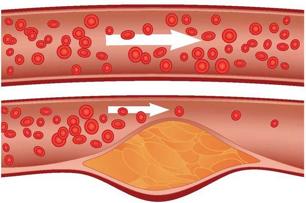 Сужение просвета сосуда атеросклеротической бляшкой