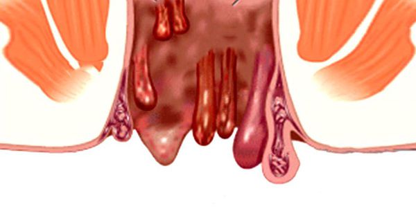 Тромбоз геморроидальных узлов
