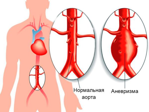 Аневризма аорты