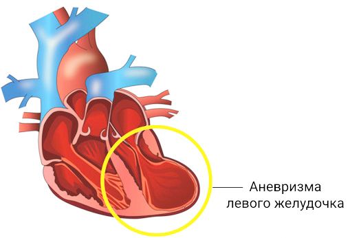 Аневризма сердца: причины, симптомы и лечение