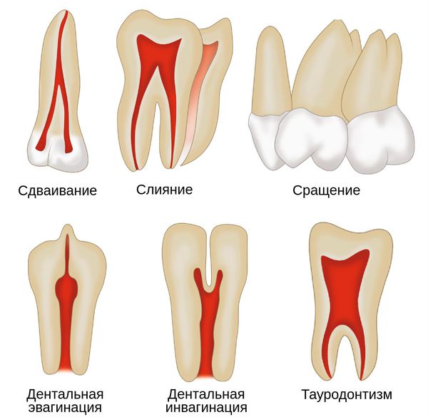 Отклонения в развитии зубов