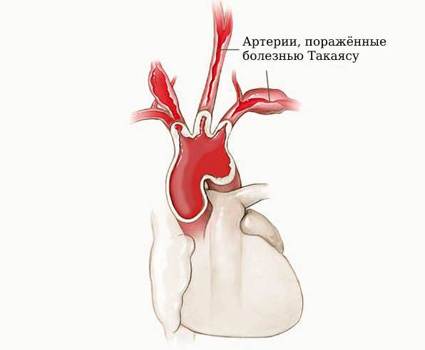 Болезнь Такаясу (неспецифический аортоартериит): причины, симптомы и лечение