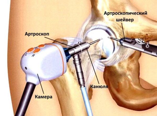 Артроскопия тазобедренного сустава