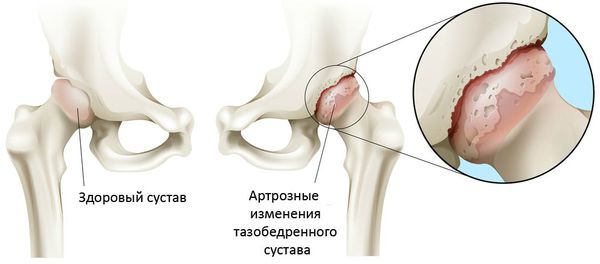 Артроз тазобедренных суставов (коксартроз): причины, симптомы и лечение