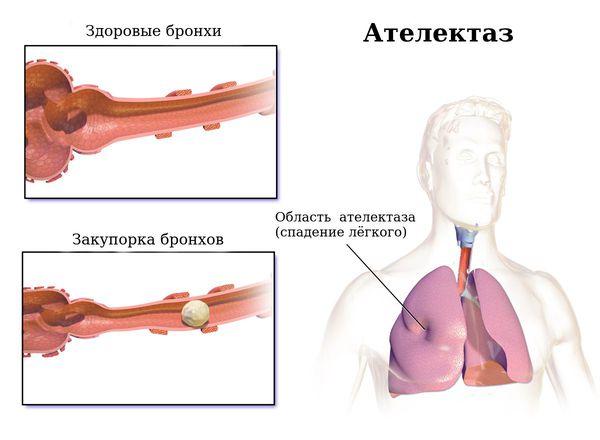 Ателектаз