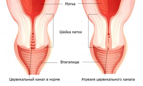 Вторичная аменорея: причины, симптомы и лечение