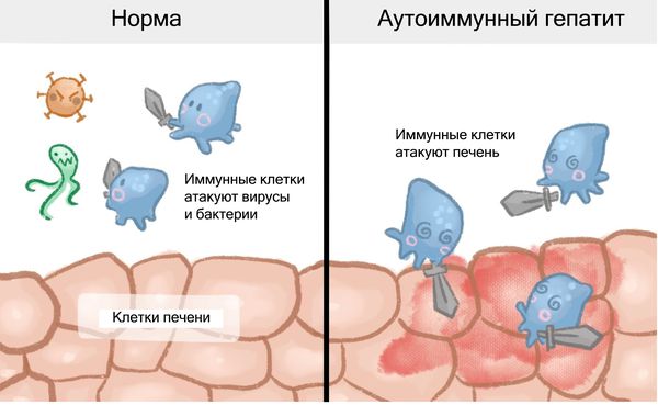 Аутоиммунный гепатит: причины, симптомы и лечение