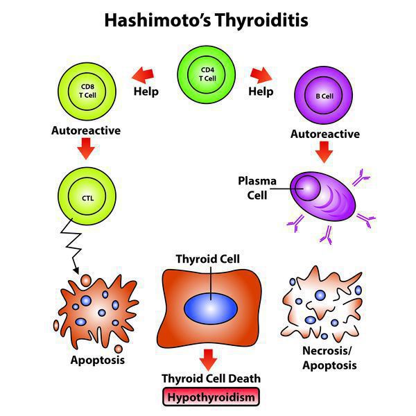 Патогенез аутоиммунного тиреоидита