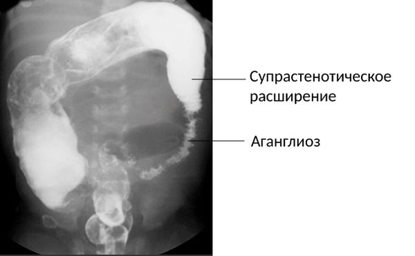 Болезнь Гиршпрунга 