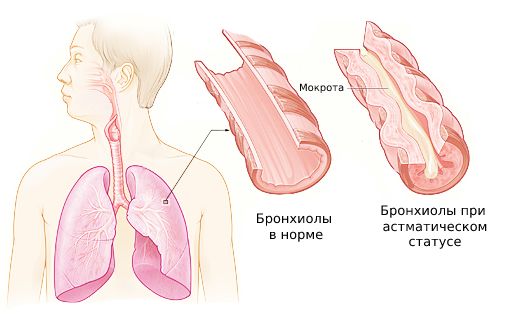 Астматический статус: причины, симптомы и лечение