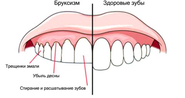 Бруксизм: причины, симптомы и лечение