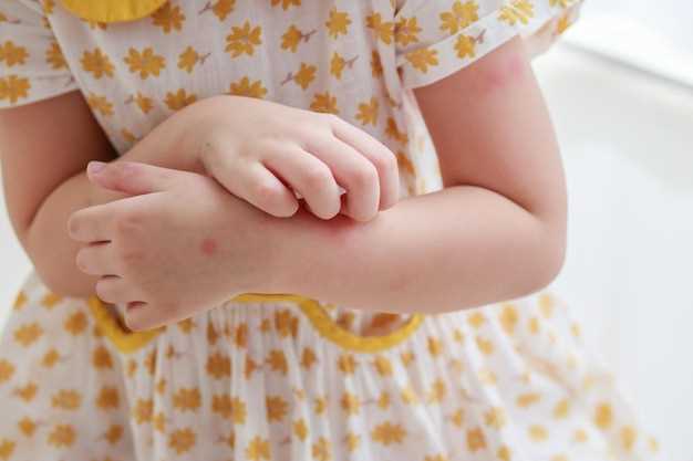 Чем и как правильно лечить контактный дерматит у ребенка