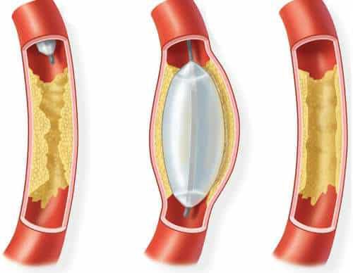 Чрезкожная баллонная ангиопластика