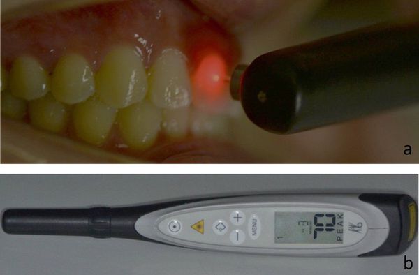 Диагностика кариеса устройством "KaVo Diagnodent"