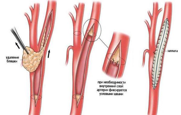 Эндартерэктомия