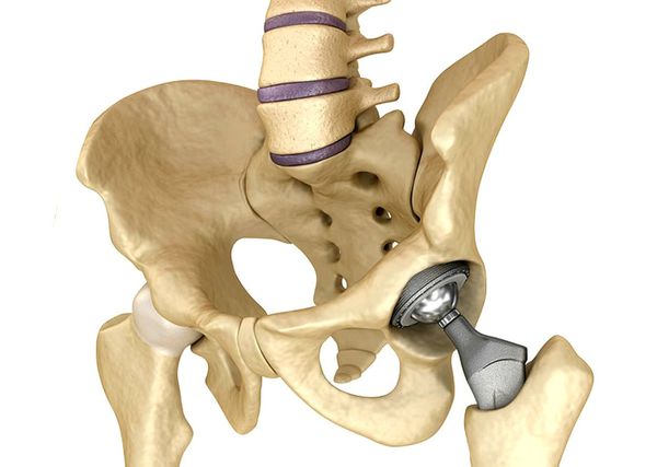 Эндопротезирование тазобедренного сустава
