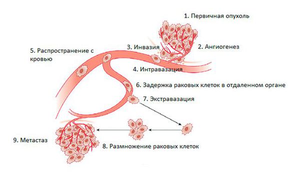 Этапы распространения метастаз