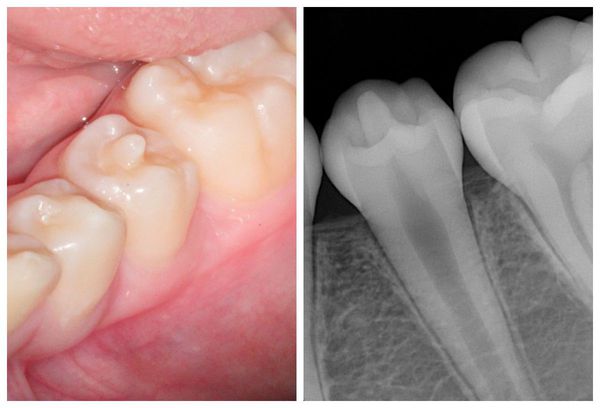 Эвагинация зуба на рентгенограмме