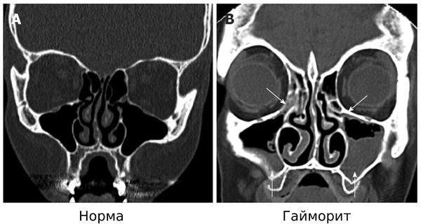 Гайморит на КТ 