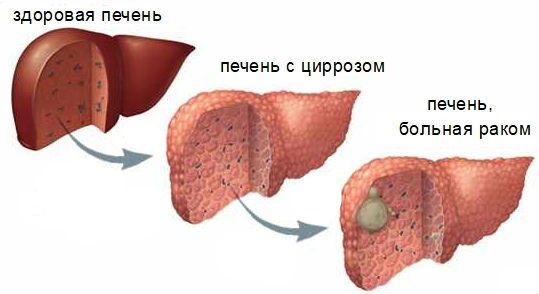 Гепатоцеллюлярный рак