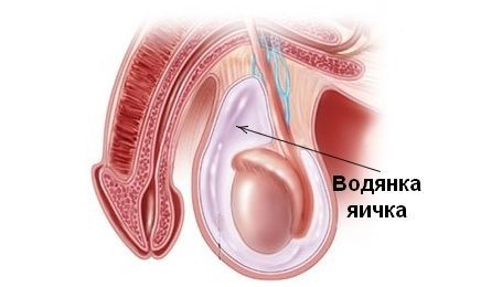 Гидроцеле (водянка яичка): причины, симптомы и лечение