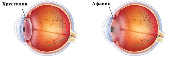 Афакия: причины, симптомы и лечение