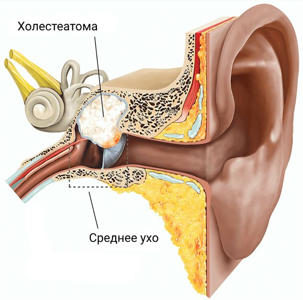 Холестеатома' data-blur='False