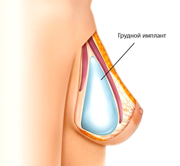 Имплантаты груди