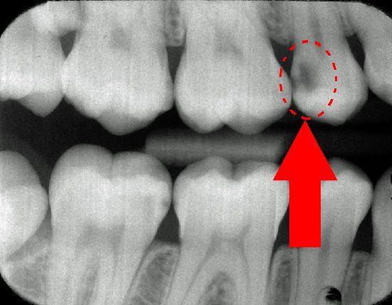 Кариозная полость на рентген-снимке