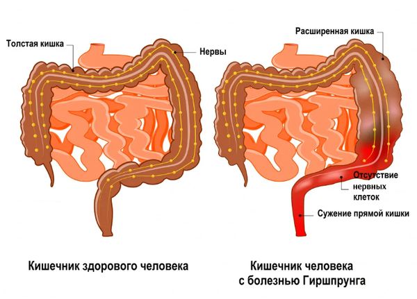 Кишечник при болезни Гиршпрунга 