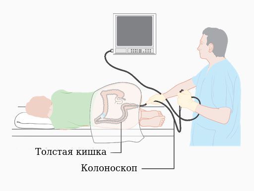 Колоноскопия