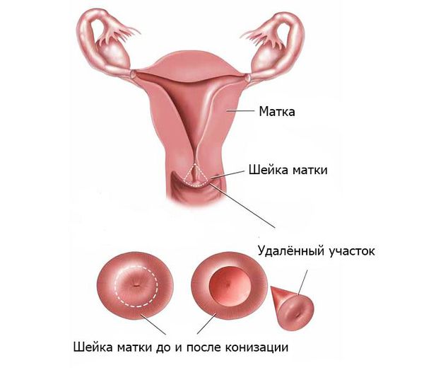 Конизация при дисплазии шейки матки