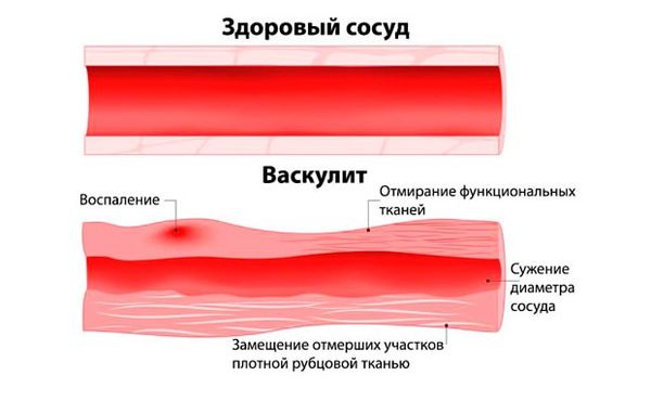 Кровеносный сосуд в норме и при васкулите