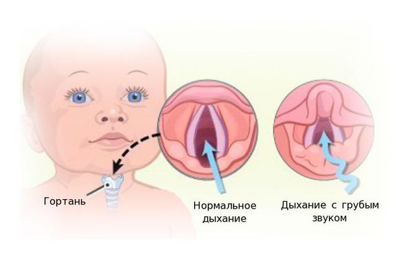 Врожденный стридор: причины, симптомы и лечение