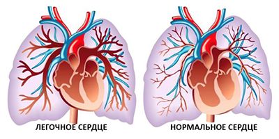 Легочное сердце