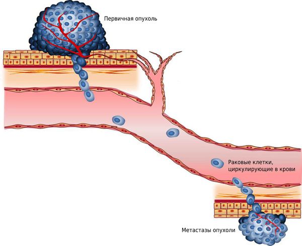Метастазы опухоли