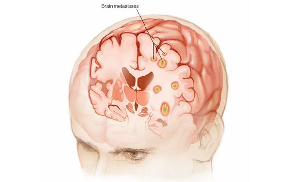 Метастазы в мозге