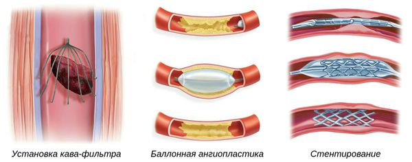 Методы восстановления кровотока