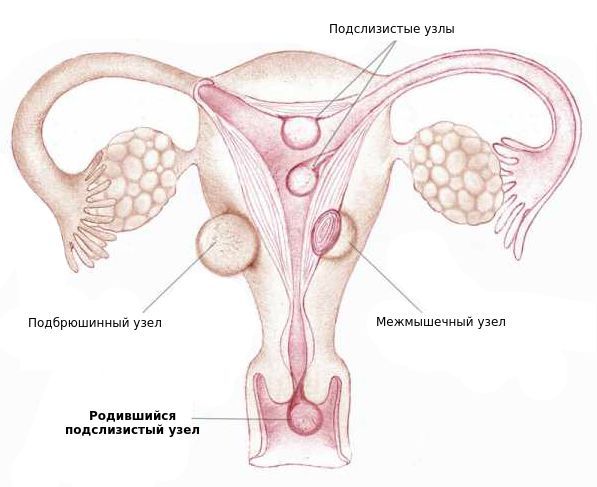 Миоматозные узлы