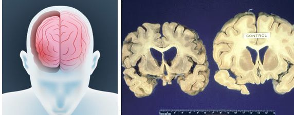 Мозг при болезни Крейцфельдта – Якоба