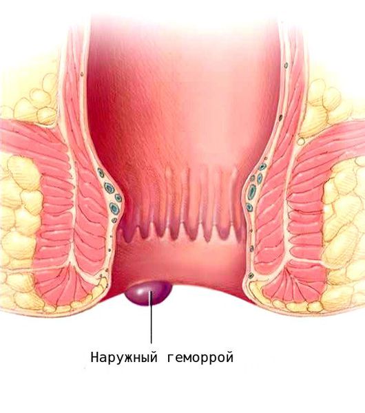 Внешний геморрой