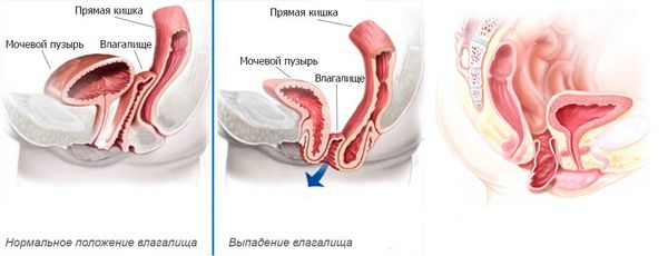 Нормальное положение влагалища и выпадение