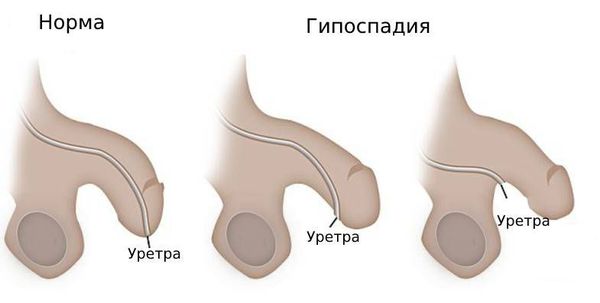 Искривления полового члена