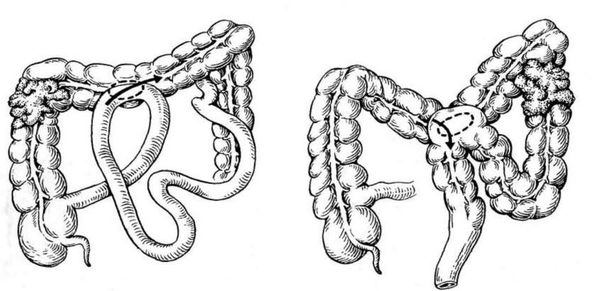 Обходные кишечные анастомозы