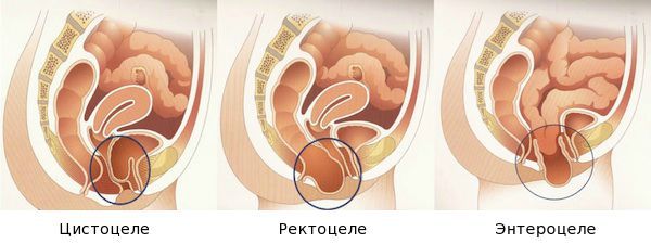 Опущение тазовых органов