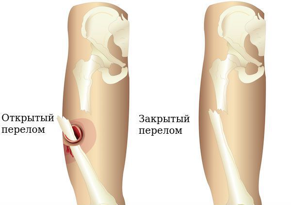 Открытый и закрытый перелом