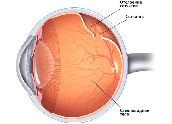 Отслоение сетчатки